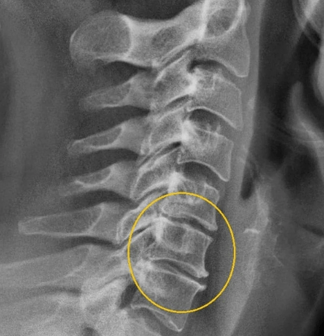 cervicale osteochondrose